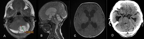 Figure 1 (A and B) Pre-operative T1W axial and T2W sagittal images reveal hyperintense bilateral retro- and supra- cerebellar subacute subdural hematoma, thickness of 2.09 cm and fourth ventricular and aqueduct compression with hydrocephalus. (C) T1W axial image shows ventriculomegaly. (D) Post op computed tomography (CT) scan demonstrating complete evacuation and improved mass effect on 4th ventricle.