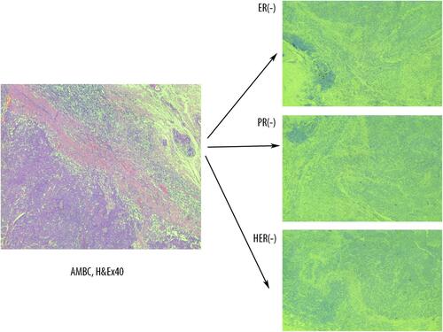 Figure 4 Triple negative atypical medullary breast cancer associated with BRCA1 mutation. AMBC – atypical medullary breast cancer. Absence of estrogen receptor (ER), progesterone receptor (PR) and HER2 immunohistochemistry expression.