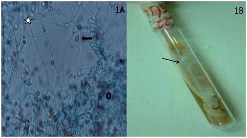 FIGURE 1. (A) Lactophenol cotton blue (LCB) mount showing pyriform-shaped, thick-walled conidia (arrow) with sparse conidiophores (star). (B) Culture on Sabouroud's dextrose agar (SDA) slant shows grayish white aerial mycelia (arrow) with radial folding.