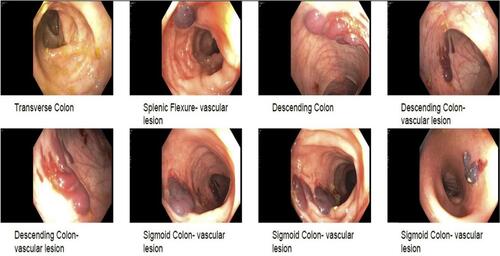 Figure 2 Colonic vascular lesions. Four discrete lesions seen in splenic flexure, descending colon and sigmoid colon, which are most likely intramural hematomas resulting from colonoscopy-induced trauma.