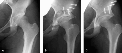 Figure 5. Lateralization type. (A) An 18‐year‐old female with Tönnis classification grade 1 OA before CPO in 2004. The CE angle and ARO are 7° and 14°, respectively. (B) Immediately after surgery, showing a conventional pubic osteotomy performed vertically to the horizontal line in CPO. (C) The CE angle and ARO have improved to 30° and ‐2°, respectively. Since the ratio of lateralization of the femoral head is 1.16, this hip is classified as the lateralization type.