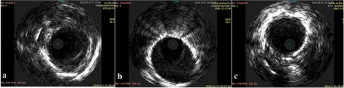 Figure 2. IVUS of the PAH-CTD group (a), the other types of PAH group, (b) and the control group (c).