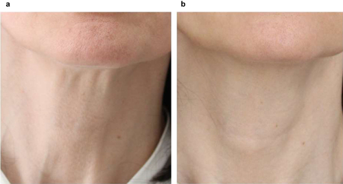 Figure 7 Neck: This 58-year-old female patient was treated with 1.5 mL of Radiesse® + 6 mL of saline (final dilution, 1:4). Radiesse® was injected with a 27 and 30 Gauge needle and a cannula with 50 mm-length and 25 Gauge-diameter (27 and 30 Gauge were both used for convenience and considering the body region). (a) At baseline, her neck skin thickness was thin (grade 2) and the facial skin laxity and wrinkles were moderate (grade 2 on the Merz scale). (b) The improvement reported at 6 months after 3 sessions of Radiesse® injection was good (grade 3).