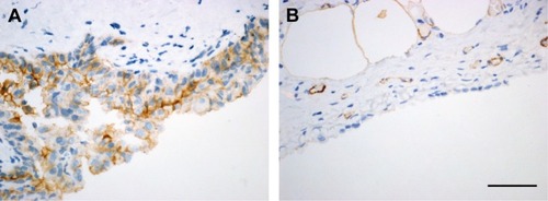 Figure 1 CD146 expression on MPM biopsies.Notes: Immunohistochemical staining of CD146 in MPM biopsies disclosed a positive reaction in tumoral cells (A) compared to the absence of signal in reactive mesothelium (B). Magnification 20×, scale bar 30 μm.Abbreviation: MPM, malignant pleural mesothelioma.