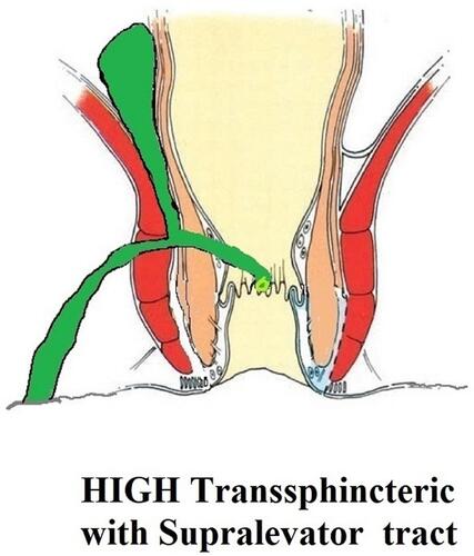Figure 2 A high transsphincteric fistula with supralevator extension.