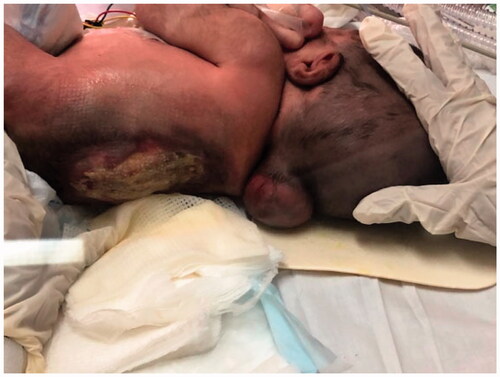 Figure 1. A large thoracolumbar meningomyelocele in a newborn.