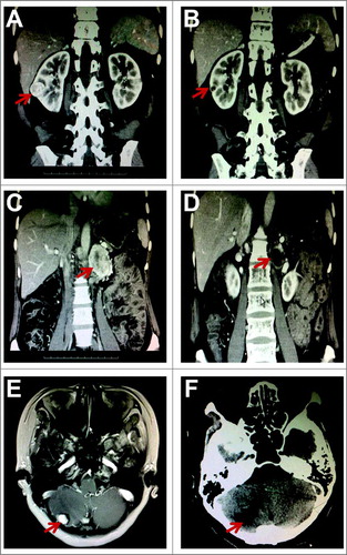 Figure 1. Computed tomography (CT) and magnetic resonance imaging (MRI) scans from Patient 1. The CT scans show the right renal cell carcinoma (RCC) and left pheochromocytoma before (A, C) and after (B, D) sunitinib treatment. The MRI scans show the hemangioblastoma in the right cerebellum before sunitinib treatment (E) and the CT scan shows the site of the lesion after the operation (F). Red arrows indicate the masses.