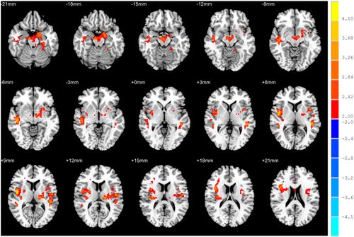 Figure 1 Comparison of the functional connectivity values in the ADHD and TDC groups. (P<0.05, after alphasim correction. The red areas indicate the brain regions in which the values of FC were higher in the ADHD group than in the TDC group).