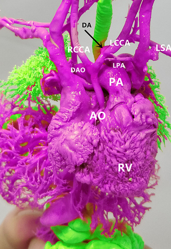 Figure 4 While the cast confirmed it was interrupted aortic arch (IAA) with descending aorta (DAO) originated from the pulmonary artery (PA), the abnormal connection of ductus arteriosus (pulmonary artery–ductus arteriosus–left common carotid artery), aberrant left subclavian artery (originated from the descending aorta), left atrial isomerism and lung lobe malformation.(black arrow: distortion of ductus arteriosus).