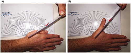 Figure 2. A Pollexograph-metacarpal angle measurement; radial adduction (A) and radial abduction (B) are evaluated using a ruler, which is placed along the first metacarpal axis (red arrow).