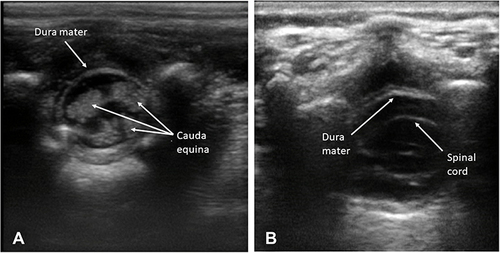 Figure 1 Ultrasound imaging in the transverse view of neonatal spine. (A) Below the conus medullaris. (B) Above the conus medullaris.
