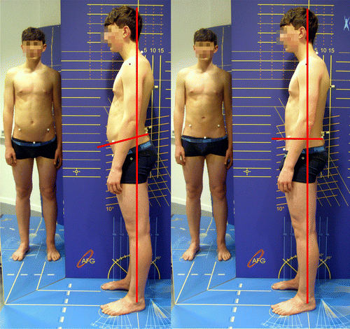 Figure 7. Voluntary reduction of pelvic tilt by a 16 year old subject after the exercise program (STR + SENSO).Note: The decrease in pelvic angle that results in a reduction of the lumbar lordosis and the improved alignment of the body in relation to the perpendicular.