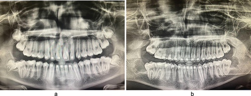 Figure 2. Two-dimensional panoramic radiograph (OPG, Panorex) images of the patient (Figure 2(a) pre-operative, Figure 2(b) post-operative).