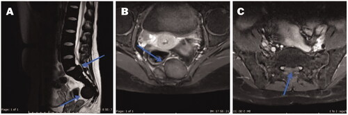Figure 4. MRI spine: (A) Sagittal T2 WI showing a diffuse low-signal intensity of the bone marrow of a well-defined isointense mass (5.3 × 3 cm) in the presacral region (blue arrow). A second mass (2 × 1 cm) in anterior extradural space posterior to S1 level (Blue arrow). (B) Mass enhancement seen in the axial postcontrast fat-saturated image at the presacral area (Blue arrow). (C) Axial postcontrast fat-saturated image at S1 level showing anterior extradural mass with slightly high signal intensity (blue arrow) at the midline, with displacement of the S1 nerve roots laterally. Note. Image taken from Clinical Case reports from a previously published article [Citation42]. The licence of the article (CC-BY) permits unrestricted reuse of the published work.