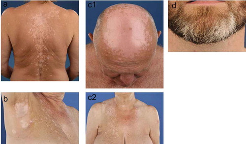 Figure 1. Clinical presentation of melanoma-associated vitiligo