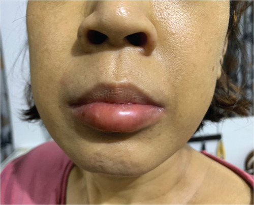 Figure 3 Lip angioedema during the second DFX graded challenge and treating through with H1-antihistamine.