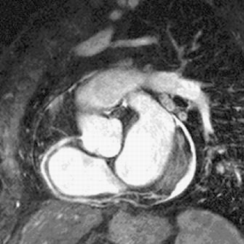 Figure 1. BTFE: Proximal right coronary artery stenosis.