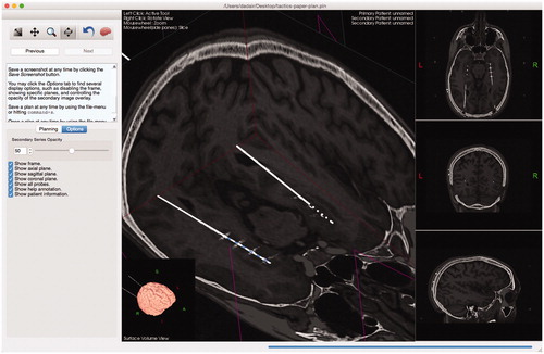 Figure 6. Users can import a secondary series that will be registered and overlaid on the preoperative data. The opacity of the secondary overlay can be controlled (slider shown in left sidebar). The implanted leads and their contacts are clearly shown to match the trajectories of the planned leads.