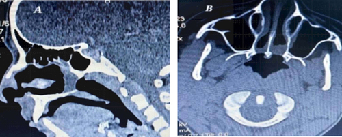 Figure 2 Bilateral choanal atresia is seen in computed tomography of the paranasal sinuses. (A) Sagittal section (B) Axial section.