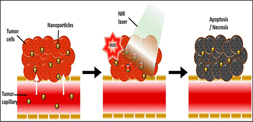 Figure 6 When exposed to near-infrared light (NIR laser), Au NPs selectively absorb and convert light into heat, resulting in localized hyperthermia and generation of ROS resulting in selective apoptosis/necrosis of cancer cells.