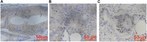 Figure 1 Immunohistochemical staining images of GSDMD in membrane (A), cytoplasm (B) and nucleus (C). 400× magnification.