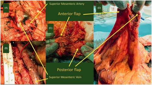 Figure 1. The D3-dissection. The figure depicts the radicality of the central dissection. (A) After opening the left side of the mesentery along a line following the medial border of the superior mesenteric artery (SMA), the surgeon opens the artery's vascular sheath. Dissecting toward the right in the well-defined plane between the vessels and their sheaths, the surgeon lifts the anterior flap. Here we see that the ileocolic artery (ICA) crosses the superior mesenteric vein in the front. (B) Now, the ICA and the ileocolic vein are ligated and divided at their origins. SMV is carefully pulled to the left as the posterior flap is dissected out from behind the SMA, still in the plane between the artery and the vascular sheath. The dorsal delimitation of this flap is Toldt’s fascia. (C) Pictures the specimen with the vascular groove and the inner surface of the two flaps. (D) Depicts the mesentery, the two flaps, and the vascular groove from another angle.