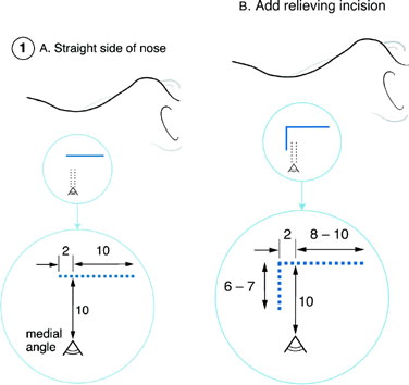 FIGURE 1 Side-of-nose DCR incisions.