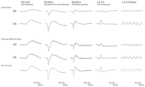 Figure 3 Full-field electroretinographics (ERGs). At the onset, the amplitudes of the rod and cone responses in the right eye are reduced to about 50% of those in the left eye. At the 1 year follow-up examination, the reduced full-field ERGs are improved to be approximately the same amplitudes as those from the left eye.