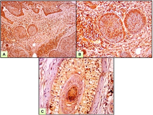 Figure 2 A case of BCC. (A) Strong nucleocytoplasmic expression of ATG7 both in tumor and surrounding stroma. (B) High power view of previous case. (C) Strong immunohistochemical expression of ATG7 in cut section of hair follicle (ATG7 IHC ×200 for A and B and ×400 for C).