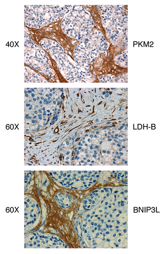 Figure 6 Aerobic glycolysis and mitophagy in the tumor stromal compartment. PKM2, LDH-B and BNIP3L are all highly expressed in the tumor stromal compartment of human breast cancers that lack the stromal expression of Cav-1. PKM2 and LDH-B are markers of aerobic glycolysis, while BNIP3L is a functional marker of the autophagic destruction of mitochondria (mitophagy). Images were reproduced from references Citation4, Citation26 and Citation27, with permission from the publisher (Landes Bioscience).