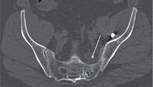 Figure 3. Considerable distortion and narrowing of the left S1 neural foramen, marked with an arrow. Note the unaffected contralateral foramen for comparison.