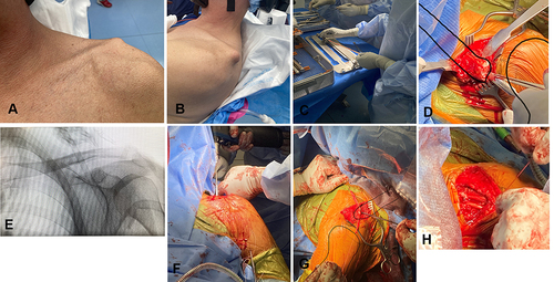 Figure 4 Reconstruction of chronic ACJ injury with semitendinosus graft. (A) Pre-operation luxation. (B) Pre-operation luxation. (C) Preparation of semitendinosus graft. (D) Preparation of clavicle. (E) Positioning of clavicle. (F) Bone tunnels. (G) Ligament reconstruction. (H) Ligament reconstruction.