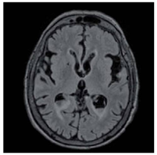 Figure 2. Axial MRI brain FLAIR image showing inflammatory debris within occipital horns of lateral ventricles bilaterally and ependymal enhancement.
