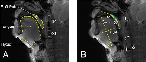 Figure 1 Schematic diagram of the tissues (A) and morphological parameters (B) to be extracted. RP: Retropalatal; RG: Retroglossal region; LLAX: The long axis of the tongue; LSAX: the short axis of the tongue; α: the angle between the hard palatal and the soft palate; β: the angle between the soft palate and the uvula; LSP: The length of soft palate. Coordinate system is built by the front upper point of C3 and the front lower point of C4.