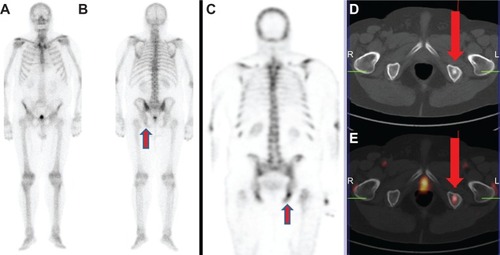 Figure 1 (A–E) A 76-year-old patient with recently diagnosed prostate cancer (prostate-specific antigen level, 18 ng/mL) underwent bone scan and positron emission tomography (PET)/computed tomography (CT) using radiolabeled choline for staging purposes. Bone scan in anterior (A) and posterior view (B) shows an area of mild radiopharmaceutical uptake corresponding to the left ischiatic bone (arrow). This finding was more evident by using single-photon emission computed tomography imaging (C).Notes: Axial CT (D) and radiolabeled choline PET/CT (E) images showed the presence of increased radiopharmaceutical uptake corresponding to an osteosclerotic lesion located in the left ischiatic bone (arrows). This finding was highly suspicious for skeletal metastasis. Biopsy confirmed the presence of a bone metastasis by prostate cancer.