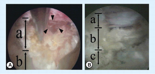 Figure 4. The ideal end point is free mobilization of neural tissue with complete herniotomy, not full exposure of the nerve root.An attempt to achieve wide exposure of the neural tissue involves the risk of neural damage. (A) In the intradiscal view, we can identify the annular fissure (arrow heads), decompressed dural sac through the undersurface of the annulus (a) and intradiscal space (b). (B) In the lateral view, we can see the anatomical layers such as the dural sac in the epidural space (a), the remaining annulus (b) and the intradiscal space (c).Reproduced with permission from Citation[14].