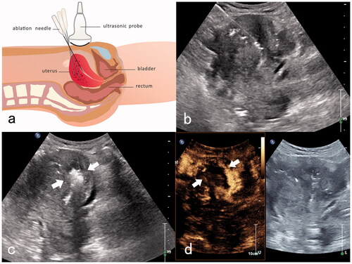 Figure 2. MEWA for an adenomyosis patient with anemia. (a) Diagram of trans-abdominal ultrasound-guided the myometrial and endometrial ablation. An ablation needle was inserted into the endometrium near the uterine fundus, and the ablation area was one-third of the endometrium near the uterine fundus. (b) Transabdominal ultrasound-guided insertion of the ablation needle into the endometrium near the uterine fundus. (c) Hyperechoic signals are detected immediately after the endometrium ablation (white arrow). (d) Post-ablation imaging reveals no perfusion of the upper one-third of the endometrium near the uterine fundus (white arrow).
