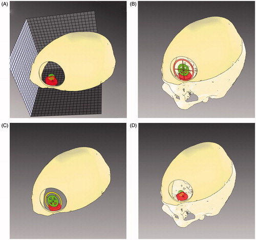 Figure 4. Surgical planning for lesion targeting. Visualization modalities conceived to aid the surgeon in planning the optimal dissection corridor for accessing the surgical target as well as for avoiding the eloquent area: A) 3 D grid effect – The sense of depth is obtained by promoting motion parallax cue through the apparent motional displacement between tumour and background by means of a 3 D grid behind the tumour. (b, c) Occluding and Non-occluding virtual viewfinders – Efficient handling of the occlusion cue between two viewfinders to aid the surgeon in aligning the surgical tool with a predefined trajectory. The first viewfinder indicates the ideal entry point for the surgical tool, whereas the second viewfinder defines the optimal trajectory of dissection. To avoid the occlusion of the real surgical field the second viewfinder, in the Non-occluding modality is moved out of the line of sight of the surgeon, behind the lesion.