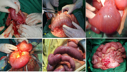 Figure 2 Intraoperative photos showing: (A and B) ileocecal intussusception in a 19-year-old female who underwent surgical exploration. (C and D) Volvulus of small intestinal in a 49-year-old male who underwent resection and anastomosis. (E) Closed Loop Obstruction in a 36-year-old male who underwent release and external (serosal) anastomosis. (F) Peritoneal carcinomatosis (mesenteric lymphoma) in a 66-year-old male who underwent a biopsy.