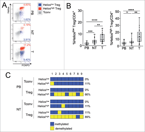 Figure 2. Helioshigh, epigenetically stable, Tregs specifically increase in tumor. (A–B) Representative Helios/FOXP3 staining in overlaid Helioshigh Tregs (red), Helioslow Tregs (blue) and Tconvs (gray) (A) and percentages of Helioslow and Helioshigh Tregs in gated CD4+ T cells (B) in PB, NT and T of CRC patients (n = 21). **p < 0 .01, ***p < 0 .005, ****p < 0 .001, by Wilcoxon matched-pairs test, two-tailed. ns, not significant. (C) The indicated subsets were FACS-sorted from PB and NT samples of a CRC patient and TSDR analysis was conducted as detailed in the Patients and Methods section. We could not perform TSDR analysis from any T specimen due to a very low yield of recovered cells. Color-coding represents the methylation status; numbers on the top indicate the sequential position of each CpG residue; percentages on the right refer to the frequency of demethylated sites.