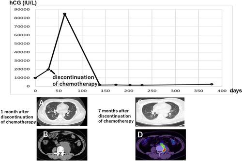 Figure 1 Spontaneous regression of metastases after the discontinuation of chemotherapy. Plain CT scans in cross-sectional views of lung metastases and retroperitoneal lymph node (RPLN) metastases at 1 month after chemotherapy discontinuation (A and B). Plain CT of lung metastases (C) and PET-CT of RPLN metastases (D) at 7 months after chemotherapy discontinuation. Both lung and RPLN metastases spontaneously regressed without further treatment. During this time, the patient’s hCG level decreased from 84,920 to 1402 IU/L.