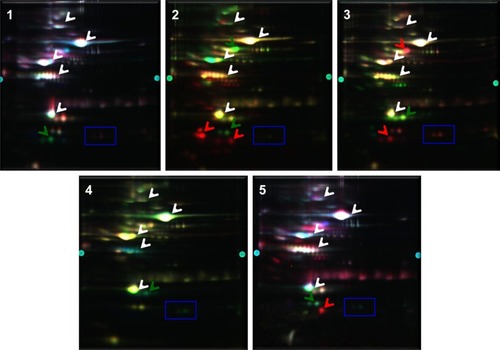 Figure 2 Differential gel electrophoretic gel images show differential protein expression between the serum of patients with Parkinson’s disease and schizophrenia. A total of five biological replicate gels were run using five sets of serum samples from patients with Parkinson’s disease and schizophrenia. Spots that equally expressed in both clinical phenotypes are indicated by white arrows. Spots that are differentially expressed are indicated by red or green arrows. Spots that are differentially expressed, with similar relative ratios and consistently present across all the five experiments, are indicated by a blue box.