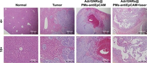 Figure 5 Histology of Adr/GNRs@PMs-antiEpCAM treatment and Adr/GNRs@PMs-antiEpCAM treatment with laser exposure.Notes: Left: normal liver tissue and HCC cell inoculation; Right: Adr/GNRs@PMs-antiEpCAM treatment only and Adr/GNRs@PMs-antiEpCAM treatment after laser exposure. Adr/GNRs@PMs-antiEpCAM with laser exposure caused significantly cell death in the tumor tissue.Abbreviations: Adr, Adriamycin; EpCAM, epithelial cell adhesion molecule; GNR, gold nanorod; PM, polymeric nanomicelles.