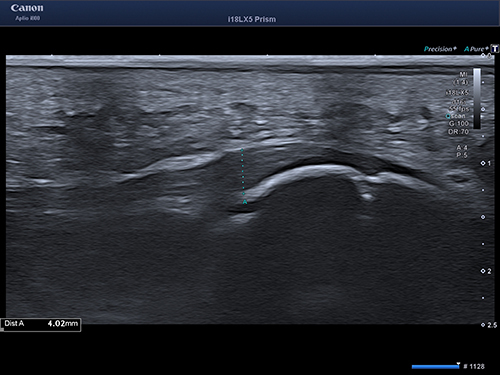 Figure 1 Plantar fascia on the right symptomatic side with a 4mm anterior-posterior diameter as slightly enlarged anterior posterior diameter is usually associated with plantar fasciitis, in this case intra-fascial bleeding (18MHz Matrix linear probe, Canon Medical Systems).