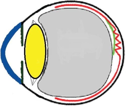 Figure 12 Schematic drawing showing gradual contraction of one edge towards the epicenter in young subjects.