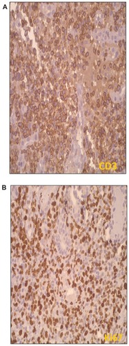 Figure 3 (A and B) CD3 and Ki67 immunoreactivity (ABC peroxidase, 40×).