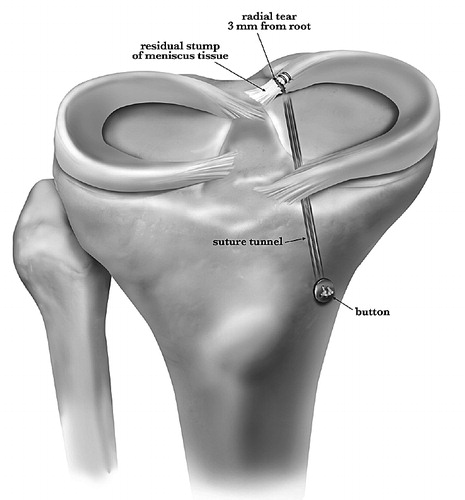 Figure 7. Preferred technique for fixation of a posterior horn medial meniscal root tear involves transosseous suture repair tied over a button on the anteromedial tibia. Proper tensioning and anatomical placement of the attachment are critical for healing and restoration of meniscal function. Reprinted with permission from Padalecki et al. (Citation2014).