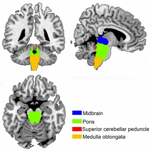 Figure 1 Four subregions of brainstem including midbrain, pons, medulla oblongata, and superior cerebellar peduncle were identified from the T1 images across the normal controls (NC) using Freesurfer 6.0 (http://surfer.nmr.mgh.harvard.edu/fswiki/BrainstemSubstructures).
