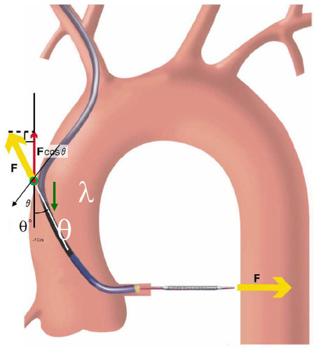 Figure 6 Backup force calculation of a guide catheter.