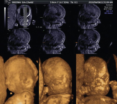 Figure 38.  Bilateral cleft lip and palate at 13 weeks of gestation. Upper; Tomographic sagittal facial imaging of the normal-karyotype anomalous fetus. Lower; 3D reconstructed images. Oblique (left), frontal (middle) and maximum-mode frontal (right) views. Maximum image shows bilateral cleft of maxillary bone.